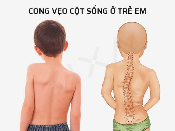 tre-cong-veo-cot-song